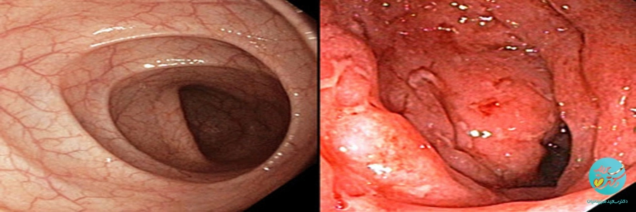 اصلاح سبک زندگی بیماری کولیت 