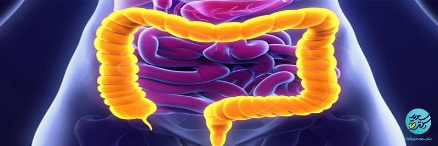 بیماری کولیت چیست؟ از علائم تا درمان های طبیعی و مکمل